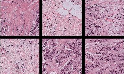 Demographic bias creeps into pathology AI, study finds • healthcare-in-europe.com